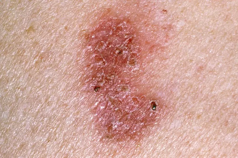 Đèn UV có hại không? Cụ thể như thế nào và lưu ý khi sử dụng - 3 Triệu chứng ung thư da